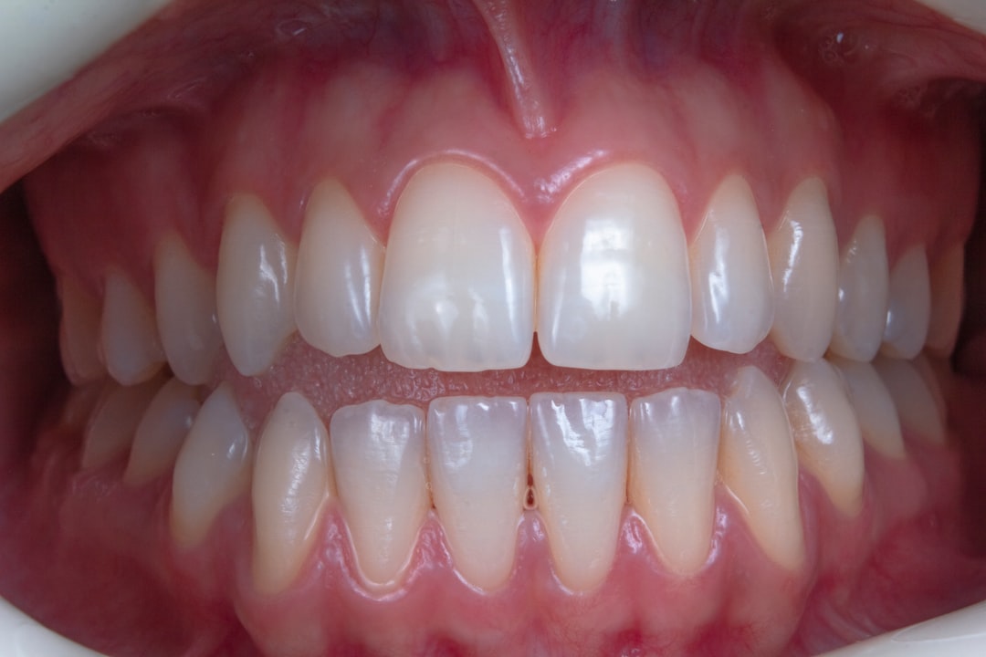 Close-up of ceramic clear braces on an adult's teeth